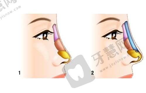 24小时男科在线免费一对一问诊，解答阴茎延长增粗价格与手术效果