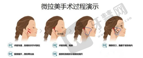 三、三维动态固定技术：8大优势破解眼袋反弹难题