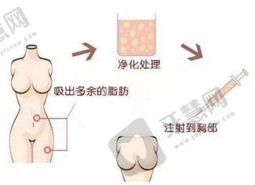 长春海峡整形医院双眼皮实例:见证真实美丽蜕变