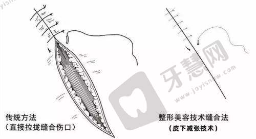 二十四种阴唇形状的意义与注意事项