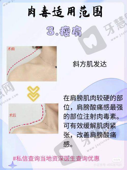 二、李衍江副主事：先天乳房矫正领域的“形态塑造大师”