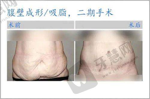 七、沈阳百嘉丽上睑下垂矫正术预约挂号指南