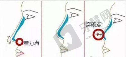 重庆华美整形美容医院奥美定隆胸取出修复优势