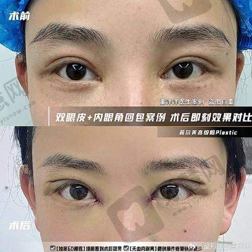 北京师丽丽眼修复价格是多少？亲身体验，丰联丽格师医生技术好收费合理