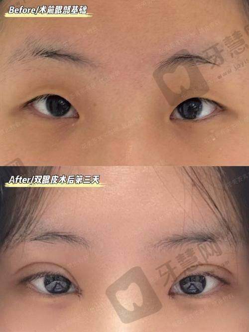 北京丰联丽格师丽丽眼修复的适应人群范围