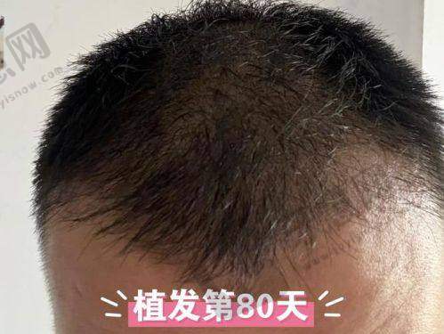 北京牛大夫植发医院项目特色