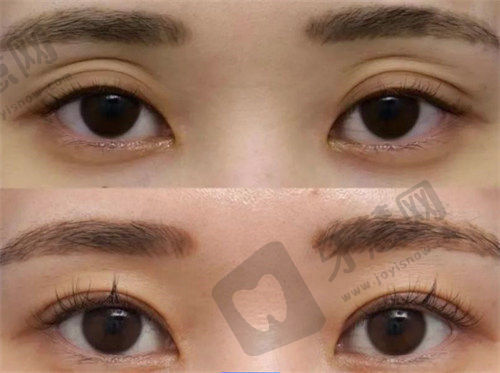 广州公立整形医院哪家好？荔湾中心齐云香隆胸隆鼻出色，口碑颇佳