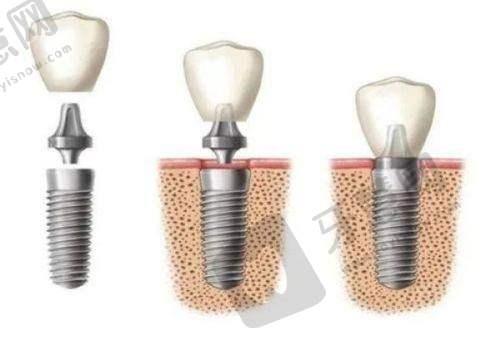 山西众植齿科医院李勇院长韩国仕诺康种植2380元起,集采一日得技术种牙稳快高性价比