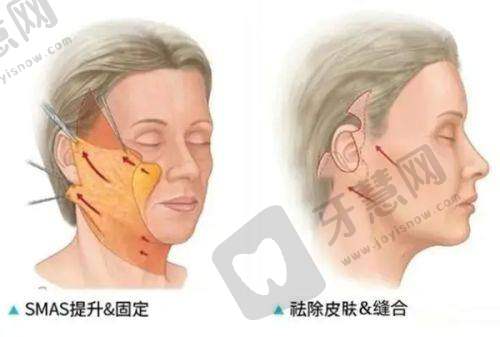 四、长沙整形医院哪家好修复强?研颜整形眼部骨干医生