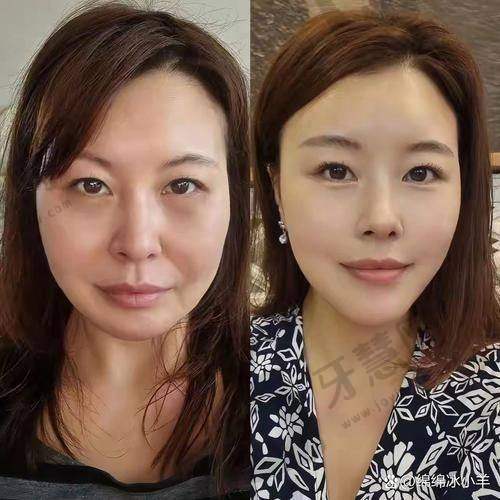 任琳医生的技术优势在女性私密维养和黄褐斑治疗中的体现