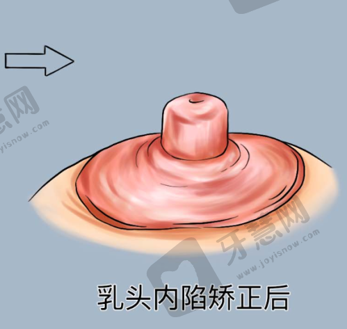成都棕南医院私密整形价格表之私密紧缩针项目