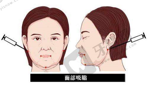 西安叶子医疗美容割双眼皮选徐佳明之前列的审美观念