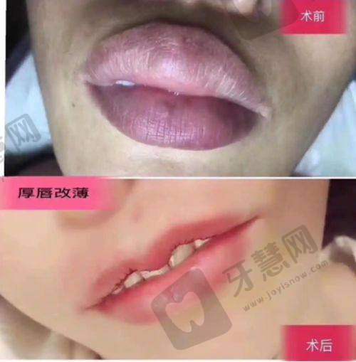 杭州艺星整形价格表之胸部整形项目