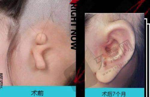 海口鹏爱医疗美容医院综合鼻整形价格之顾客口碑
