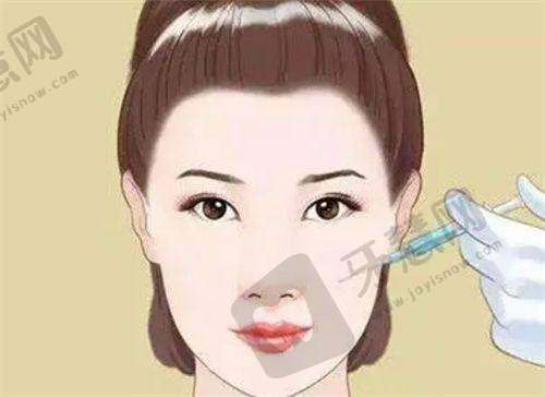 杭州张龙做鼻子多少钱？艺星坐诊技术优价格1万起，口碑好评多