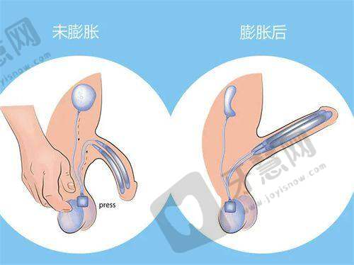 眼修复收费标准3万+拉皮手术价格5万+:患者的真实反馈