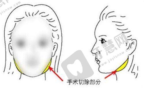 武汉美立方整形价格表之其他整形项目
