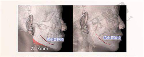 相关知识科普:激光去眼袋手术