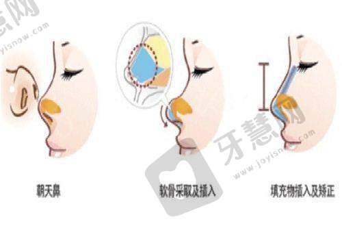 北京师丽丽双眼皮手术价格之修复价格情况