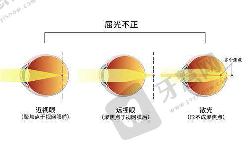 爱尔眼科医院怎么预约？网上/电话/到院预约挂号流程全攻略