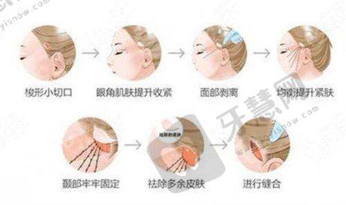 姐妹们都在问的重庆卢美均星眸眼双眼皮避坑之手术价格考量