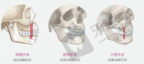 襄阳熙蒙整形价格表之其他整形项目价格