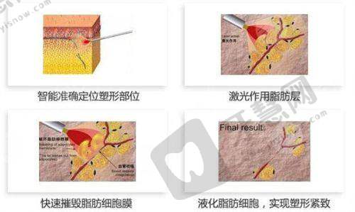广州海峡整形价格表更新之吸脂塑形