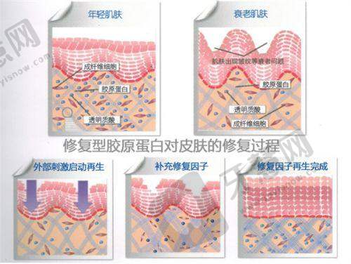 刘金超双眼皮修复实例分享:手术过程与技术优势