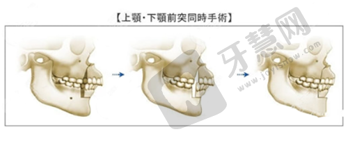 上海王衡健医生做双眼皮park法1W起之患者真实实例反馈
