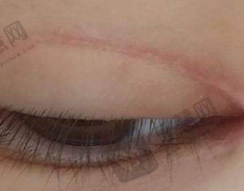 王新磊医生眼睛修复怎样之成效呈现
