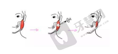 金华薇琳整形价格表查询——胸整形价格