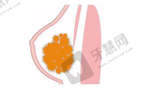 徐晓斐双眼皮修复价格不高，丰富实例见证技术实力