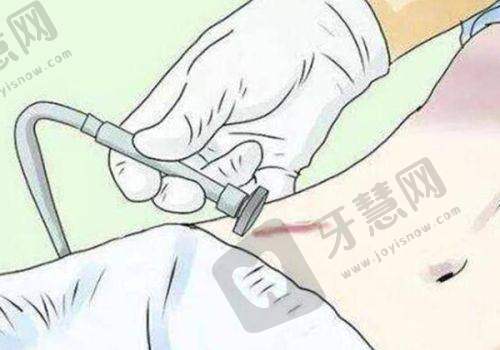 杭州艺星整形真人实例分享