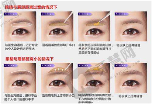 林潮割双眼皮价格是多少钱——选择林医生的优势