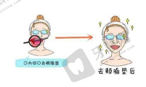 南宁美丽焦点整形价目表公布——吸脂项目价格