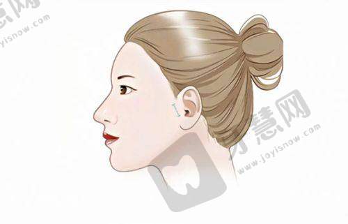 徐晓斐双眼皮修复价格不高，良好口碑源自顾客认可