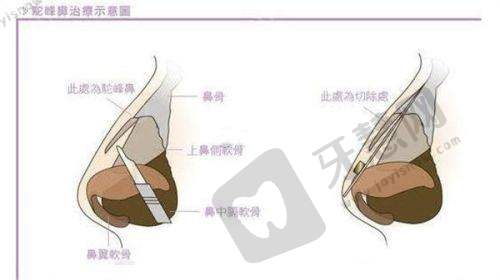 赤峰紫洁叶子医疗美容双眼皮8551元起——多种双眼皮价格选择