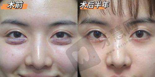 南京比较好的双眼皮修复医生之汪树杰
