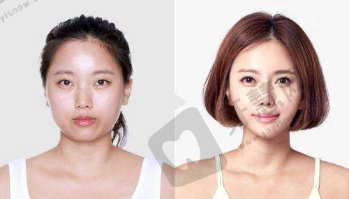 合肥双眼皮谁割得比较好？合肥台美丽格医疗美容门诊部叶凡医生