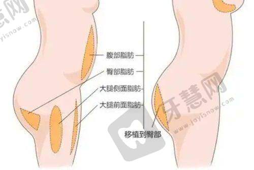 长沙亚韩整形医院价格表大全 - 胸部整形项目收费