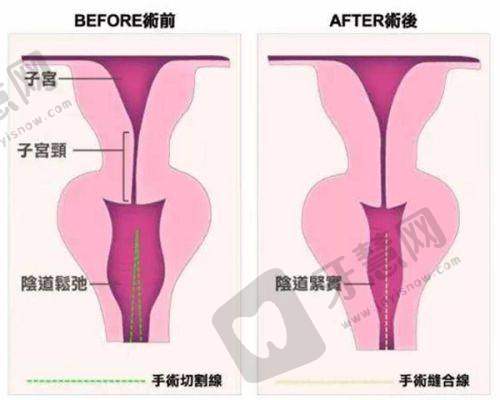 长沙亚韩整形医院价格表大全 - 其他整形项目收费