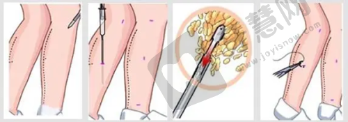 合肥做双眼皮著名医生有谁？曹林/孙洋等医生技术优、案例效果好
