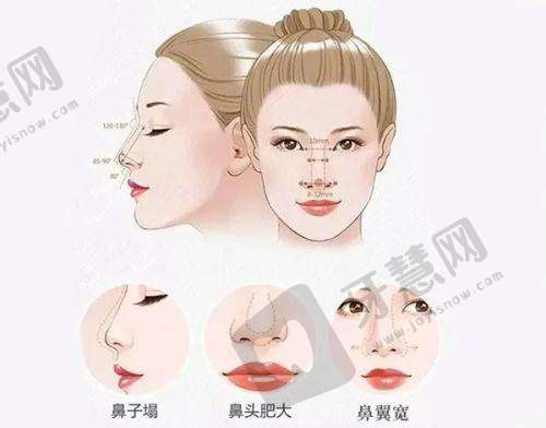 合肥双眼皮修复周瑜做的好吗？——技术优势体现