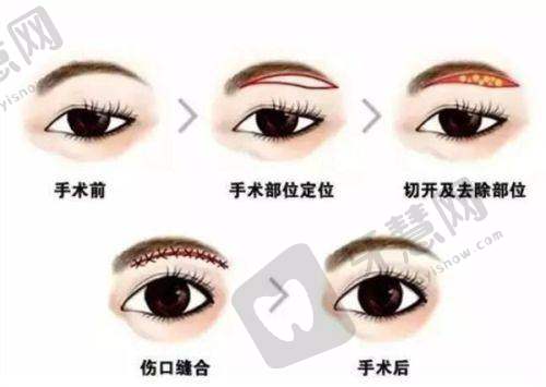 合肥双眼皮修复更好的医生之周瑜