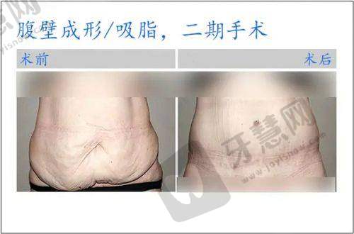 合肥做双眼皮重要医生之程光