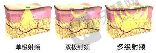 南京吸脂去哪家——南京连天美美容医院