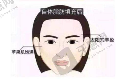合肥双眼皮修复更好的医生之徐和林