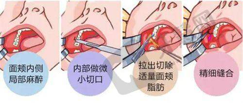 FD四维植发技术详解