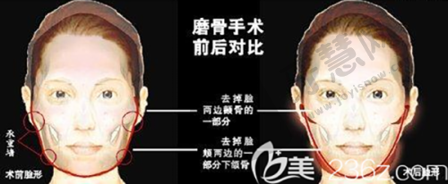 嗨体熊猫针多少一支