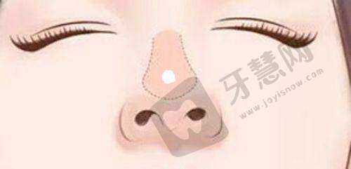 南京抽脂手术哪个医院好之南京康美